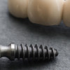 Implants dentals