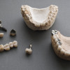 Pròtesis dentals